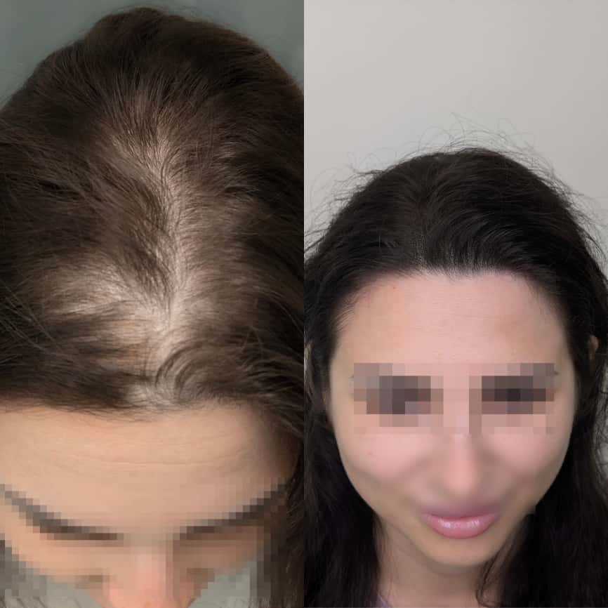 Risultato trattamento prima e dopo