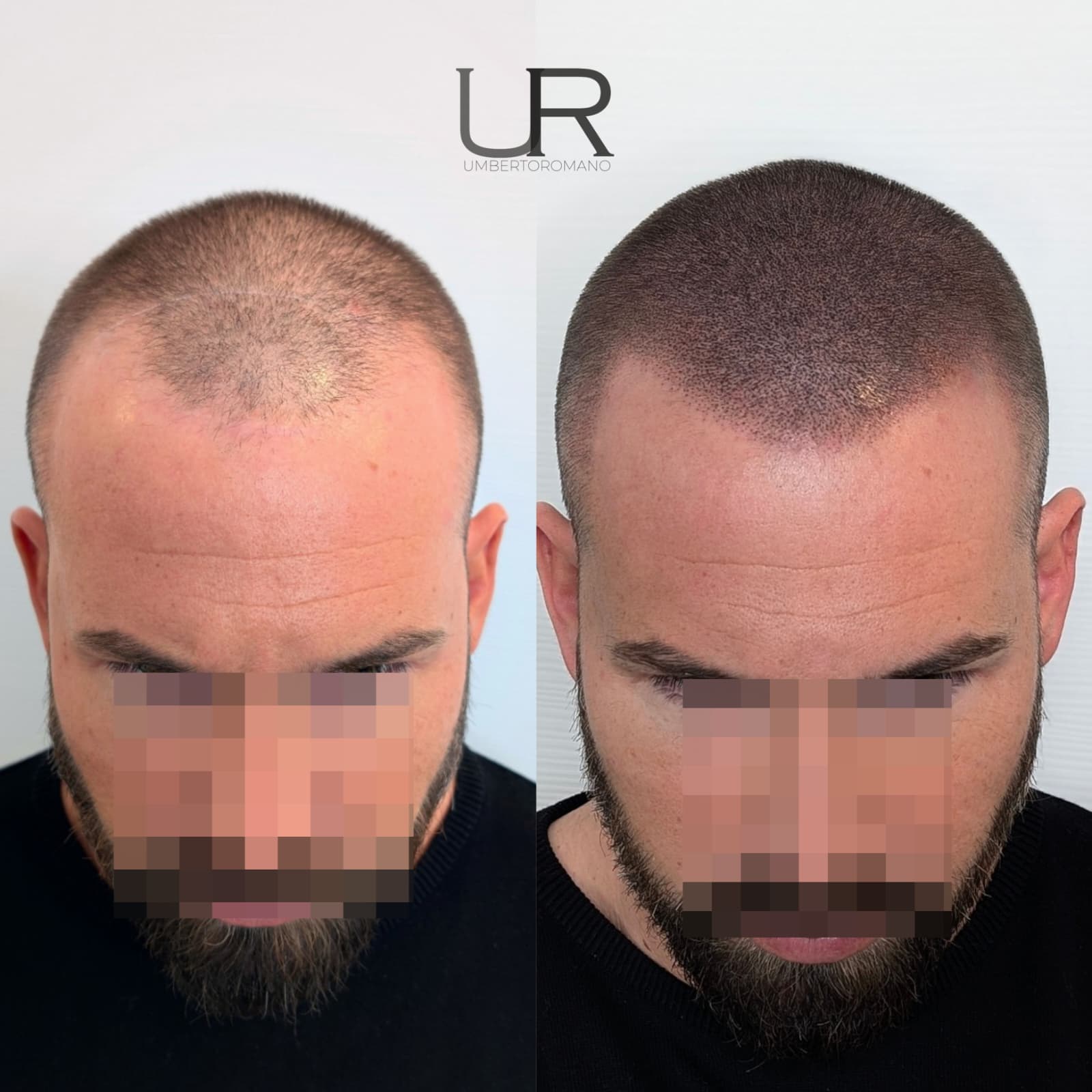 Risultato trattamento prima e dopo